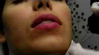 Silicone Lip Augmentation in Austin TX by Dr Mike Escobedo [upl. by Aliber737]