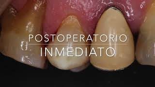 Odontosección Horizontal Premolar superior [upl. by Barrett736]