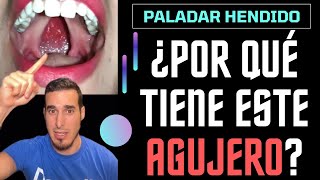 ¿Por qué tiene este AGUJERO en el PALADAR [upl. by Sacha979]