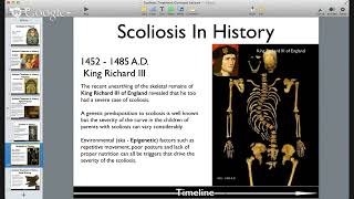 Big History of Scoliosis Treatment [upl. by Aynwad]