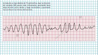 Torsades de pointes  Clases EKG 44 [upl. by Eimile]