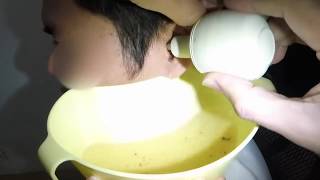 Flushing Earwax SO MUCH WAX Clogged Ear with Water [upl. by Chandless]