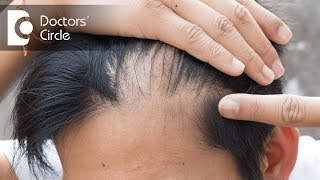 Is there a permanent treatment for male pattern hair loss  Dr K Prapanna Arya [upl. by Smiga]