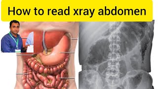 x ray of abdomen  x ray abdomen interpretation  x ray abdomen reading  abdomen radiology [upl. by Annayd]