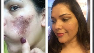 How to hidecover stubborn acne scarsbirth mark with makeup Power of makeup [upl. by Petty813]