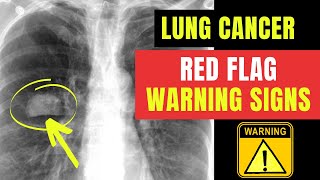 How to spot RED FLAG warning signs amp symptoms of LUNG CANCER Doctor ODonovan explains [upl. by Dewayne390]