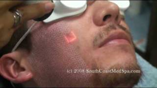 Active FX Laser Acne Scars Removal [upl. by Zennas]