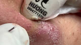 Make your Acne Treatment Huong Da Nang  479 acne 2022 [upl. by Antoinetta321]