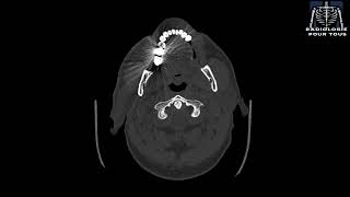 SCANNER DES SINUS Rhinite chronique avec sinusalgies [upl. by Nolubez]