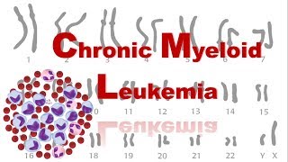 Chronic Myeloid Leukemia  CML  Philadelphia Chromosome [upl. by Oballa116]