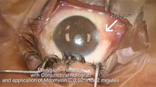 Pterygium removal with conjunctival autograft and mitomycin C Shannon Wong MD 52817 [upl. by Cirone]