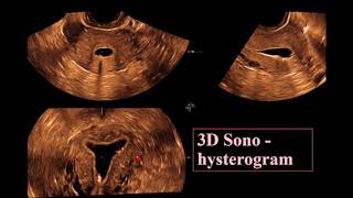 The Endometrium ultrasound [upl. by Neleh]