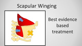 Scapular Winging Causes and Treatment [upl. by Sello]