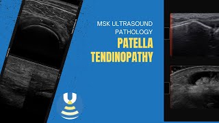 Patella tendinopathy [upl. by Eleira]