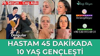 Pb Serum  Cog İp Askı Ve Dolgularla Hastam 45 Dakikada 10 Yaş Gençleşti [upl. by Etom]