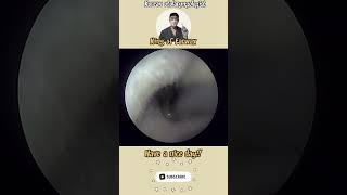 귀지형 콧물 부비동염 축농증 비염 코청소 이비인후과 rhinorrhea rhinitis sinusitis asmr [upl. by Gerc]