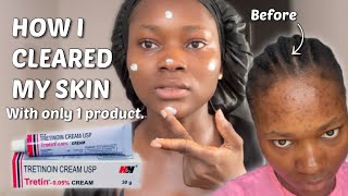 THE TRETINOIN NIGHT ROUTINE THAT CLEARED MY SKIN  Step by step Tretinoin routine tretinoin [upl. by Abramo717]