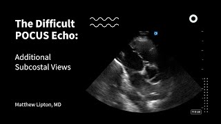 The Difficult POCUS Echo Additional Subcostal Views [upl. by Damaris]