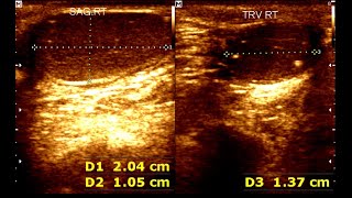 Cryptorchidism in children  Testicular Microlithiasis  Undescended testis [upl. by Rhiamon]