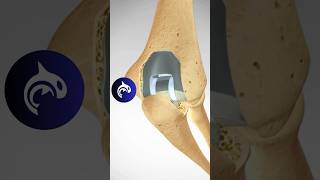 Total Elbow Replacement TER anatomy elbow surgery [upl. by Emolas175]