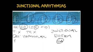 ECGJunctional Arrythmias [upl. by Attenehs]