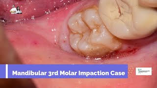 Mandibular 3rd Molar Impaction [upl. by Alyose]