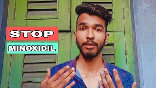 6 months minoxidil beard growth journey results review how to grow beard 🪴 minoxidil beard [upl. by Hplodnar]