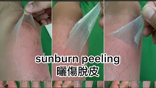 sunburn peeling🌞嚴重曬傷 [upl. by Olotrab]