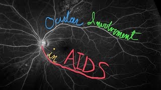 Ocular Involvement in AIDS [upl. by Samalla]