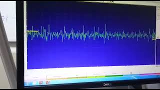 DIVE BOMBER SOUND EMG FINDING IN MYOTONIA [upl. by Nahsaj]