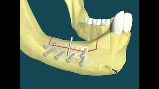 Dental Video of Distraction Osteogenesis [upl. by Ytrebil128]