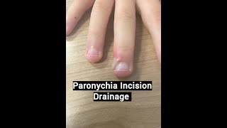 Paronychia Treatment [upl. by Naik]