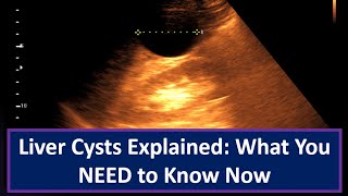 Liver Cysts Explained What You NEED to Know Now [upl. by Nais]