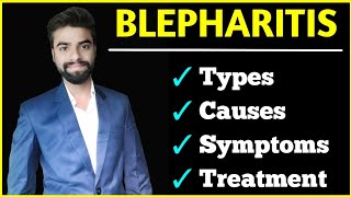 Blepharitis in hindi  Blepharitis Eye lid margin inflammation  How is it treated  Abhishekinsight [upl. by Kenimod283]