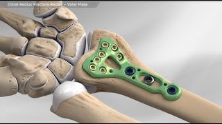 Distal Radius Fracture Repair  Volar Plate [upl. by Lawlor]