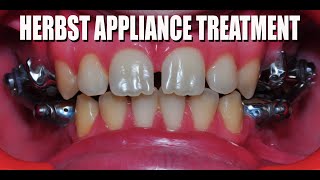 HERBST APPLIANCE TREATMENT CASE PL  IN 169 FORMAT [upl. by Meehar]