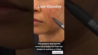 LIPODISSOLVE FAT DISSOLVING MESOTHERAPY INJECTION  CHUBBY CHEEKS [upl. by Tyree]