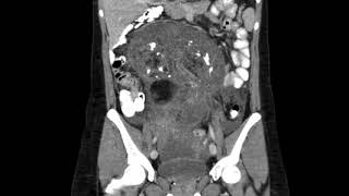 Ovarian Teratoma Coronal CT [upl. by Bartolome668]