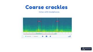 Lung sounds  coarse crackles [upl. by Llenehc]