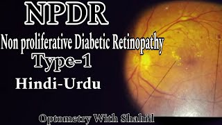 Non Proliferative Diabetic Retinopathy  Part1  Optometry With Shahid [upl. by Dorlisa]