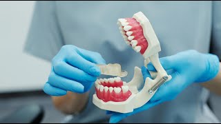 A Novel Technique for the Fabrication of Maxillary Obturator Using Combination of PEEK [upl. by Naugal]