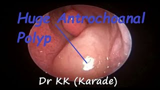 Huge Antrochoanal Polyp on Endoscopic Nose Examination [upl. by Liana]