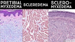 Pretibial Myxedema vs Scleredema vs Scleromyxedema  Dermatopathology quotSoundAlikesquot [upl. by Merline]