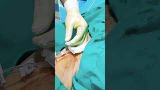 central line insertion steps femoral line insertion procedure central line kaise dalte hain [upl. by Ettenan]