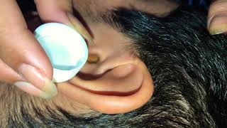 DESTAPANDO oido de niño con agua oxigenada  Ear wax removal [upl. by Naillij]