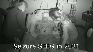 Seizure Clips of Epilepsy Progression [upl. by Sabrina]