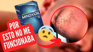 1 MES usando minoxidil para la barba lampiño real  resultados reales [upl. by Innavoj868]