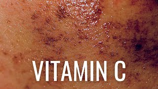 HOW Vitamin C PREVENTS Hyperpigmentation [upl. by Leasa159]