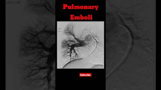 Pulmonary Emboli shorts pulmonaryembolism radiology pulmonarydisease [upl. by Furgeson]