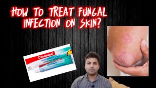 Canesten cream  Clotrimazole 1 cream  How to treat fungal infection on skin [upl. by Manoff]